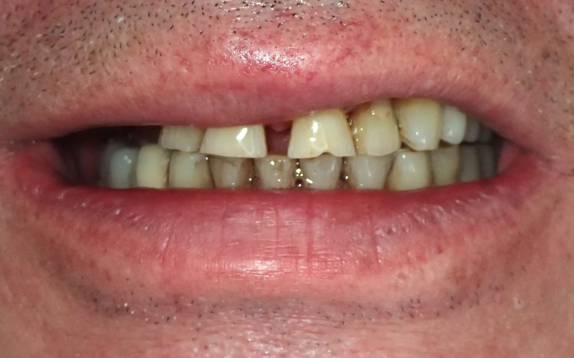 Four-stage sequence of front crowns being replaced