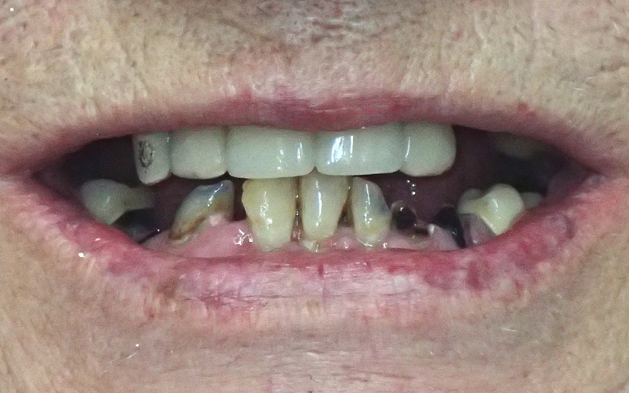 Before and after of a brightened, straightened female smile